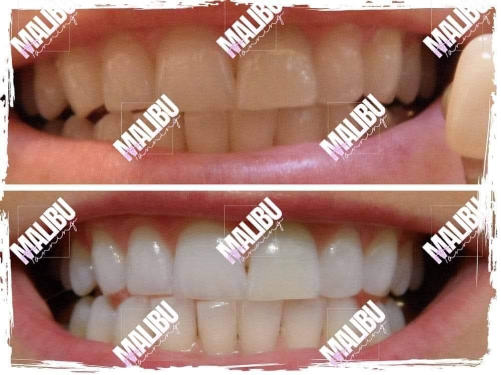 Sunbed Teeth Whitening Pens